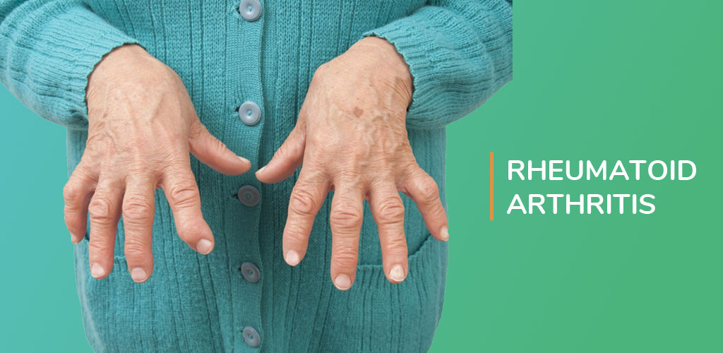 RHEUMATOID ARTHRITIS