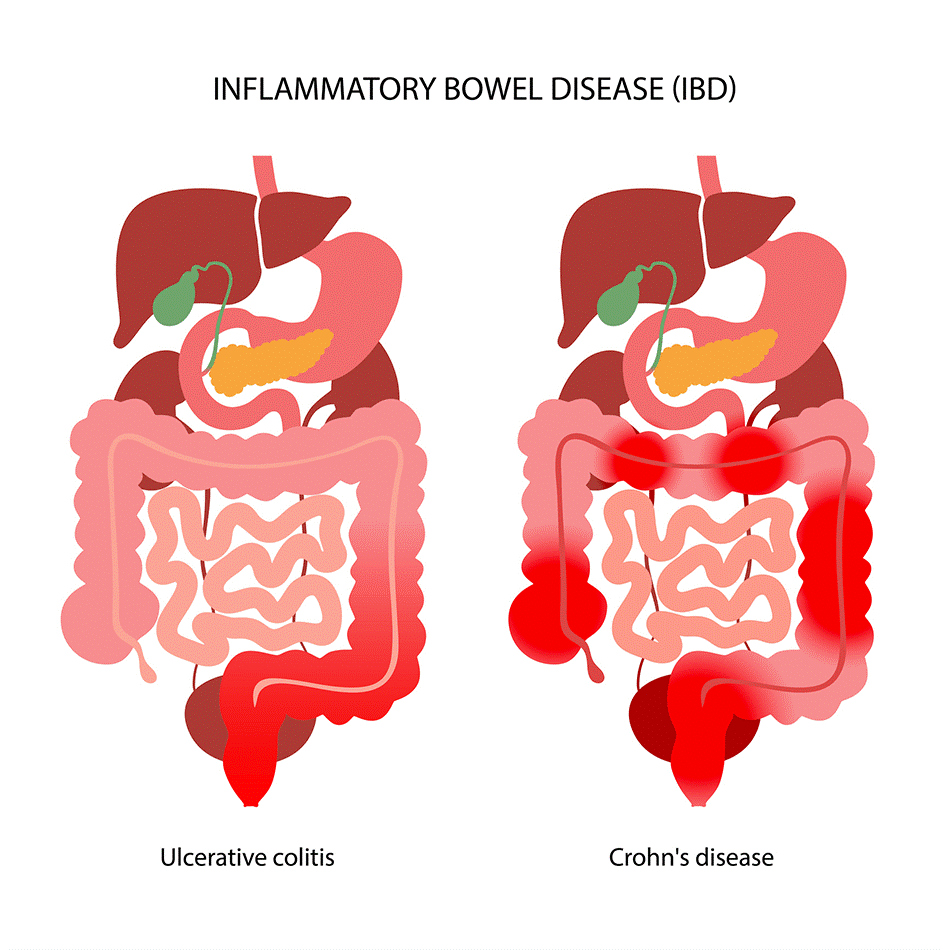 rising-incidence-of-inflammatory-bowel-disease-ibd-a-cause-for