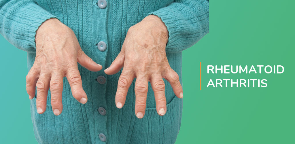 Impact of Abatacept in Preventing Rheumatoid Arthritis UPSC