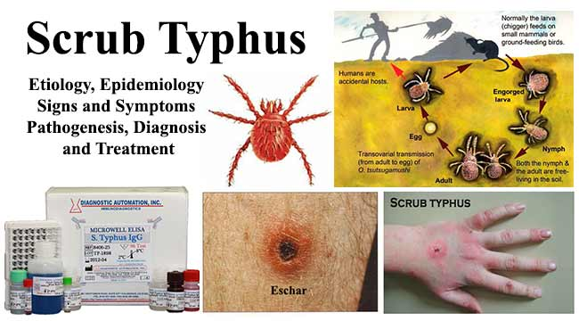 Kerala Issued An Alert Against Scrub Typhus