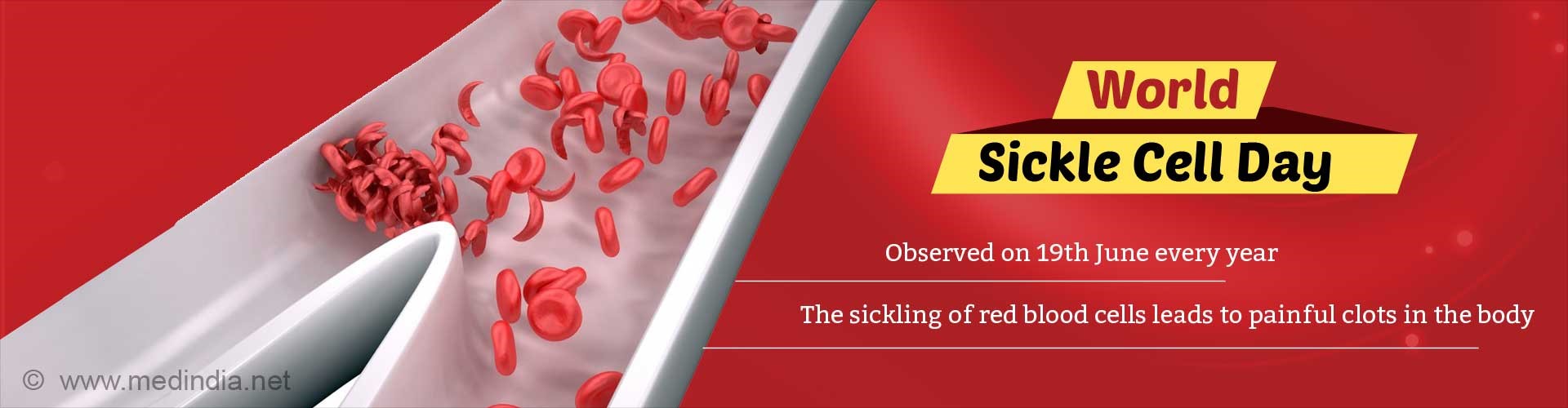 World Sickle Cell Awareness Day - Ias Gyan