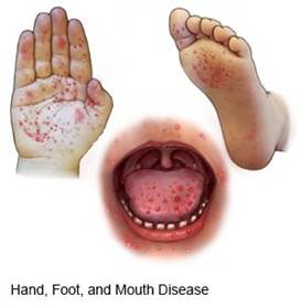 Hand, Foot, and Mouth Disease | IAS GYAN